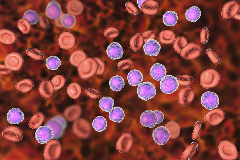 Acute lymphoblastic leukemia