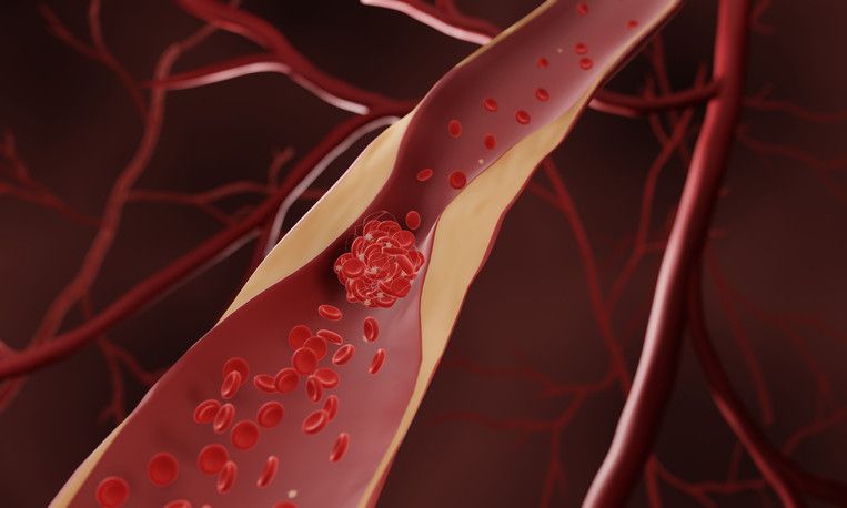 ateroskleróza